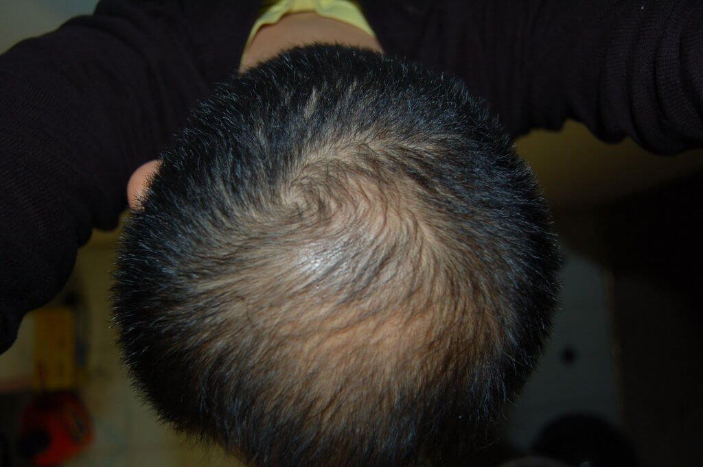 Alopecia en Hombre